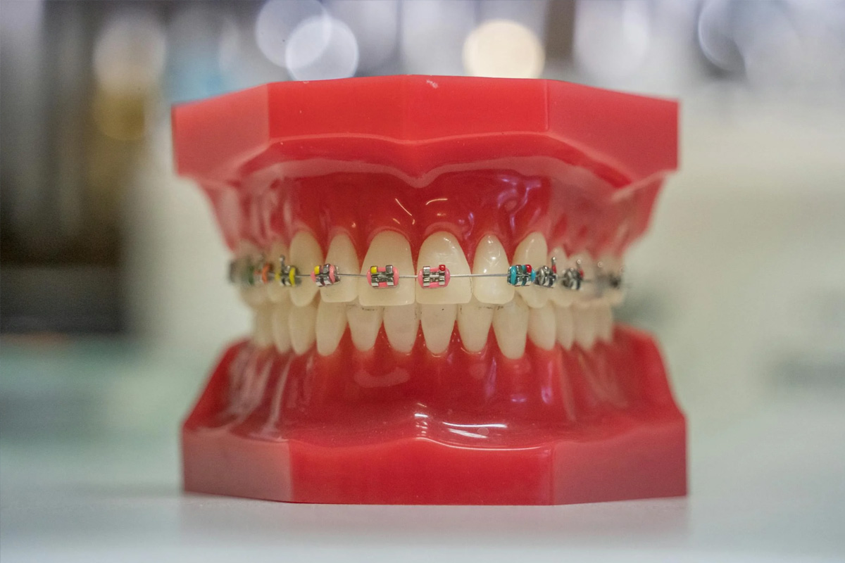 Dental Implant in Vasundhara, Ghaziabad