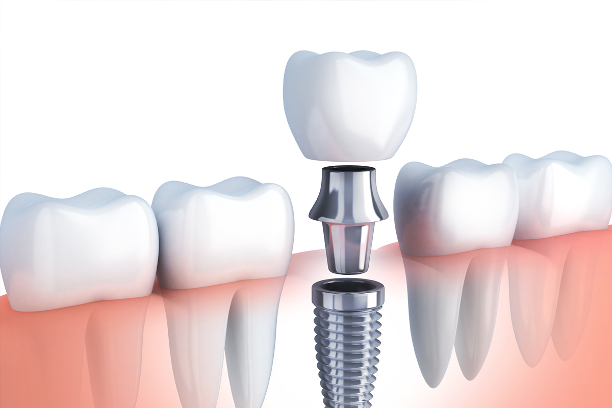 Dental Implant in Vasundhara, Ghaziabad