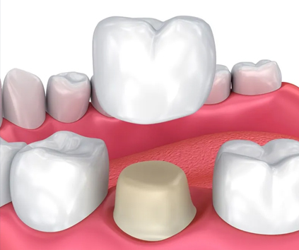 Dental Implant in Vasundhara, Ghaziabad