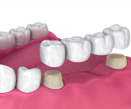 Dental Implant in Vasundhara, Ghaziabad