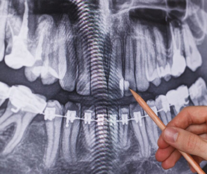 Dental Implant in Vasundhara, Ghaziabad