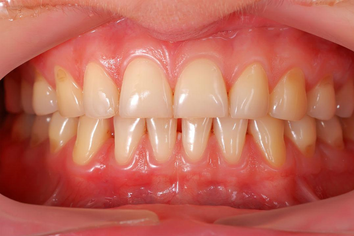 Dental Implant in Vasundhara, Ghaziabad