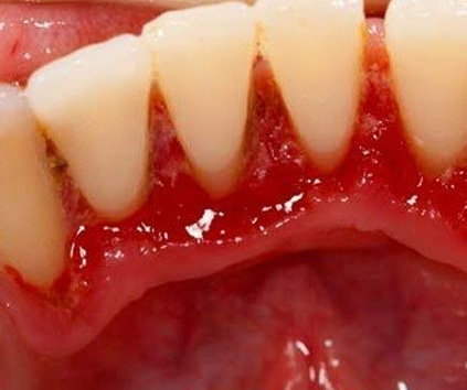 Dental Implant in Vasundhara, Ghaziabad