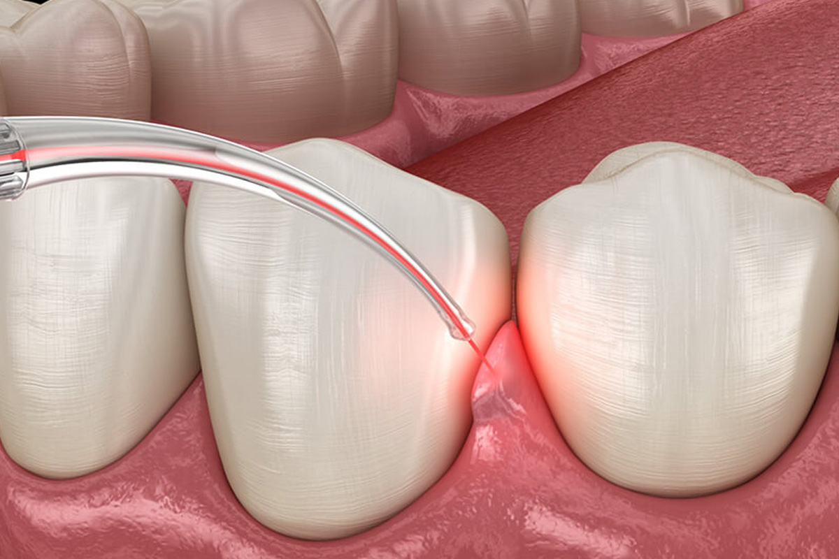 Dental Implant in Vasundhara, Ghaziabad