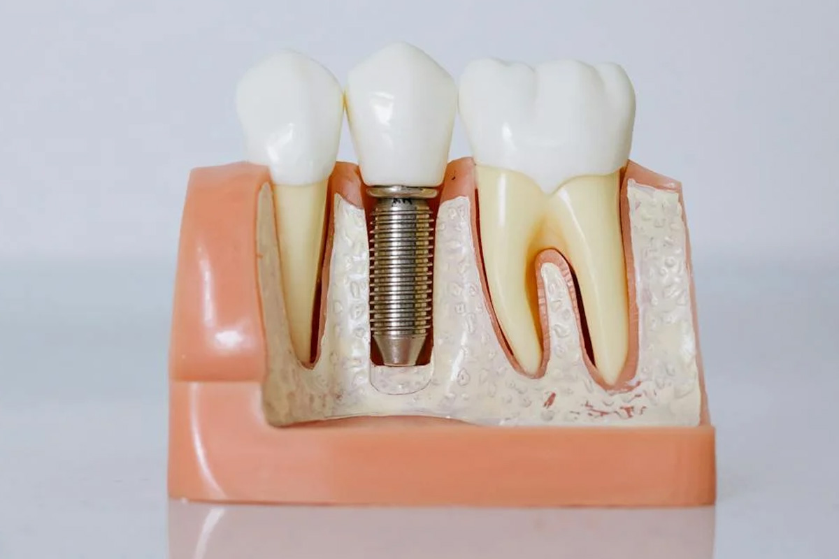 Dental Implant in Vasundhara, Ghaziabad