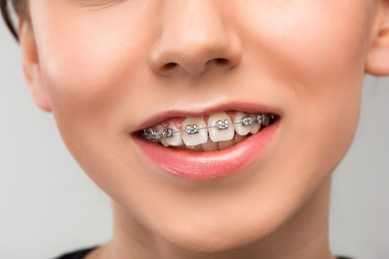 Straightening Smiles: The Comprehensive Guide to Dental Braces.