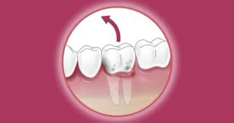 Unveiling Precision: The Art and Science Behind Surgical Extraction.