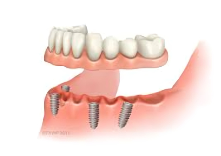 Fixed Teeth: A Permanent Solution for a Confident Smile.