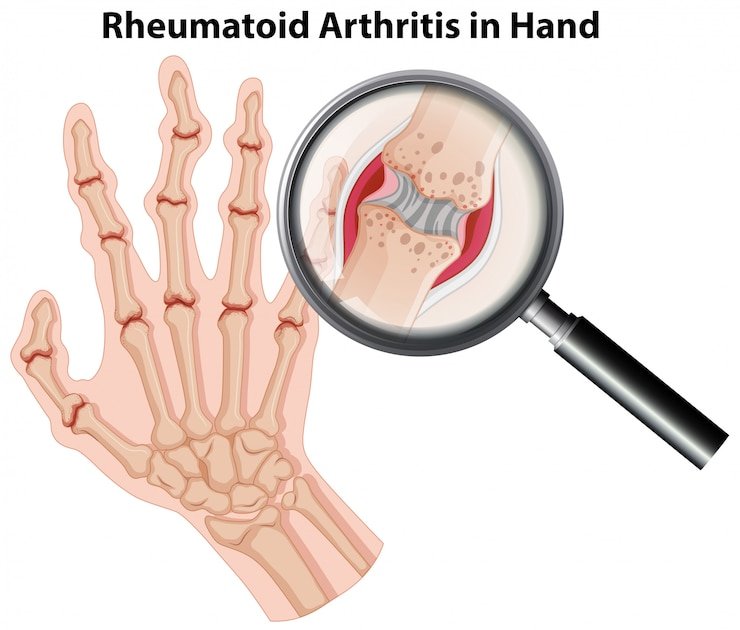 How to Evaluate Arthritis Treatment Options in Safdarjung Enclave.