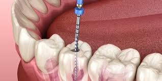 Top Benefits of Single-Visit Root Canal Treatment in Indirapuram