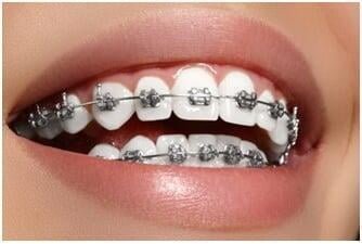 Best Dental Braces Clinic in Vasundhara